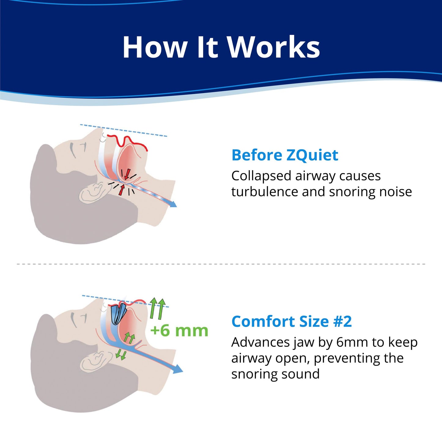 ZQuiet, Anti-Snoring Mouthpiece, Comfort Size#2, Single Refill, Clear, Made in USA, BPA-Free, Medical-Grade Material