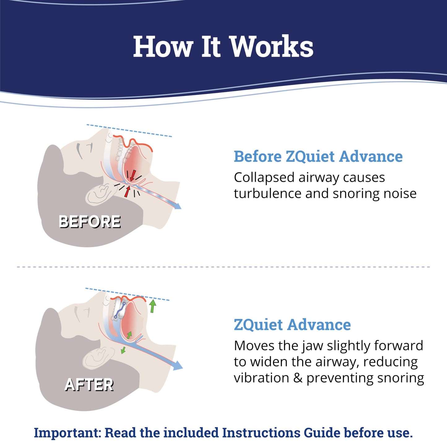 ZQuiet, Advance, Custom Anti-Snoring Mouthpiece, Adjustable Mouthguard with 4 Jaw Advancement Sizes, Slim & Low-Profile, Clear