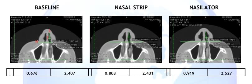 Made in USA! Nasilator Anti-Snoring Devices - Soft and Flexible Nasal Dilators | Improves Breathing & Sleeping | Snoring Solution | Reusable & Better Than Nasal Strips Pack of 4 (Medium)
