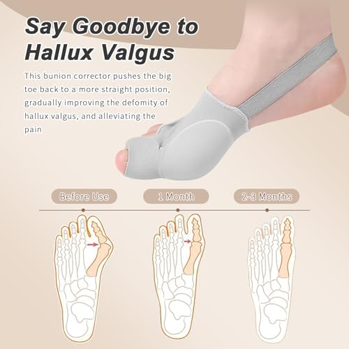 2Pcs Bunion Corrector/Splint/Brace for Women & Men, Big Toe Straightener/Separators for Hallux Valgus Pain Relief & Correc...