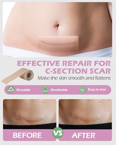 SOFTCA C Section Recovery Must Haves Kit - Peri Bottle,Disposable Mesh Underwears,Witch Hazel Pad Liners,Silicone Scar Pat...
