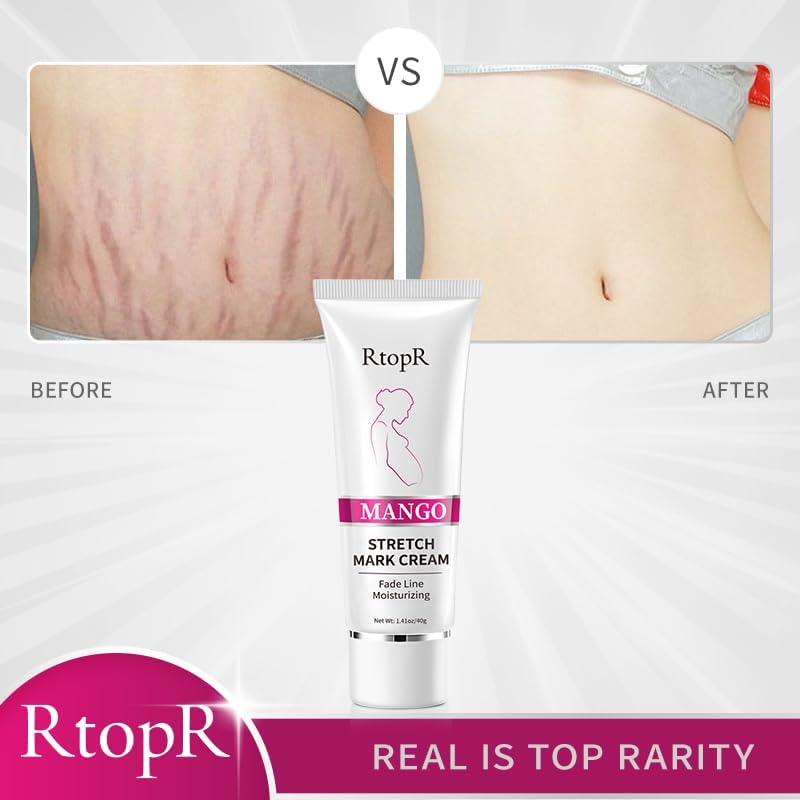 Stretch Mark Removal Cream, Obesity Stretch Mark Moisturizer, Postpartum Repair Stretch Mark Cream, Abdominal Stretch Mark Cream, Remove Marks (2 PCS)