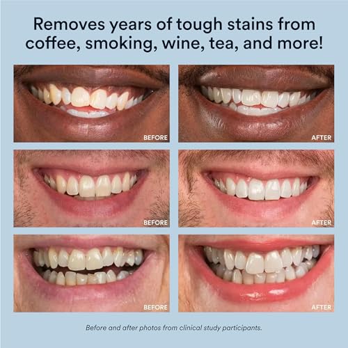 Auraglow Teeth Whitening Kit, LED Accelerator Light, 35% Carbamide Peroxide Teeth Whitening Gel, 20+ Whitening Treatments,...
