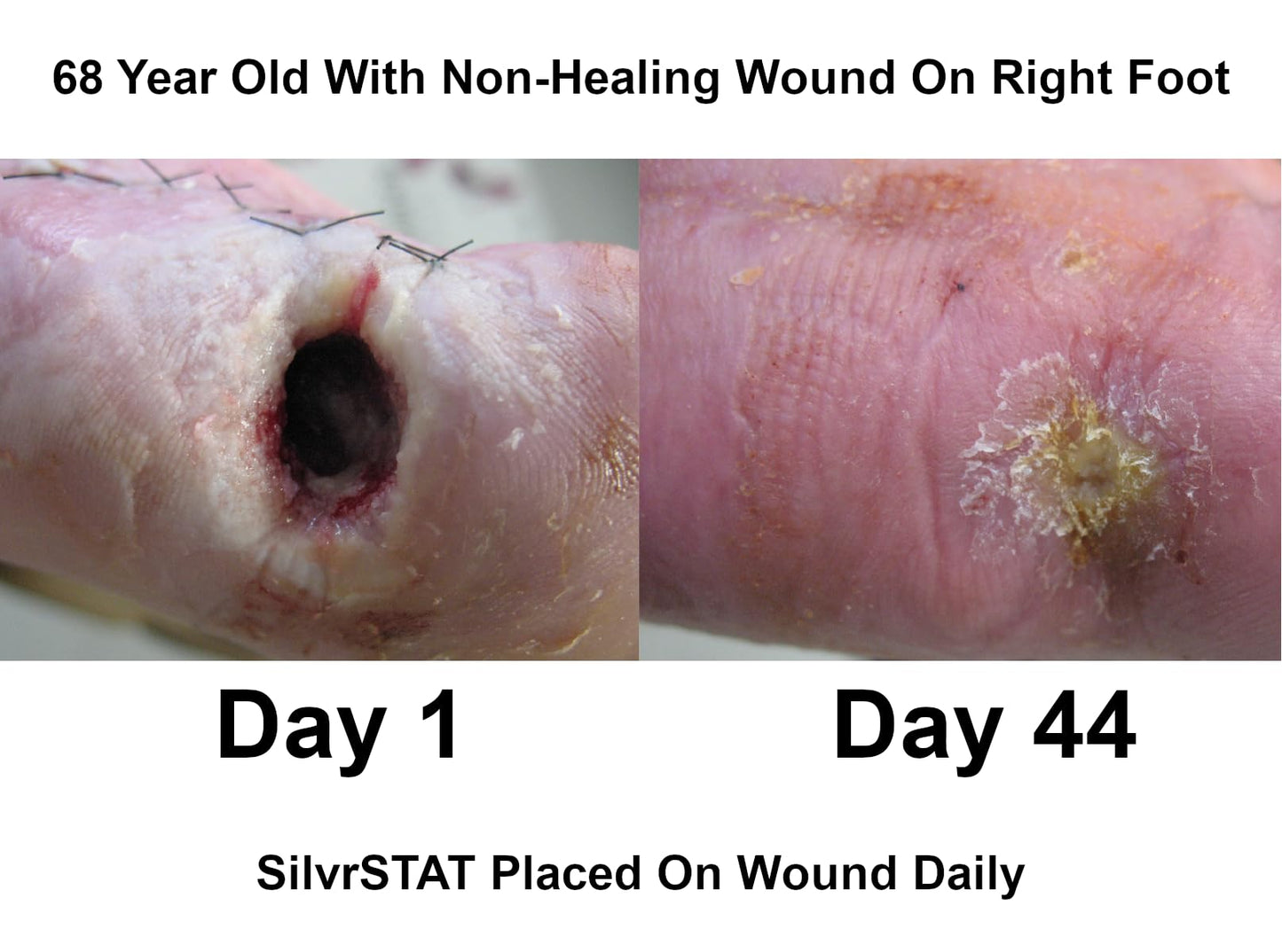 SilvrSTAT First Aid Kit Gel, 32 PPM Silver Healing Wound Dressing Gel, SilverSol Ag₄O₄ Particles, 1 oz