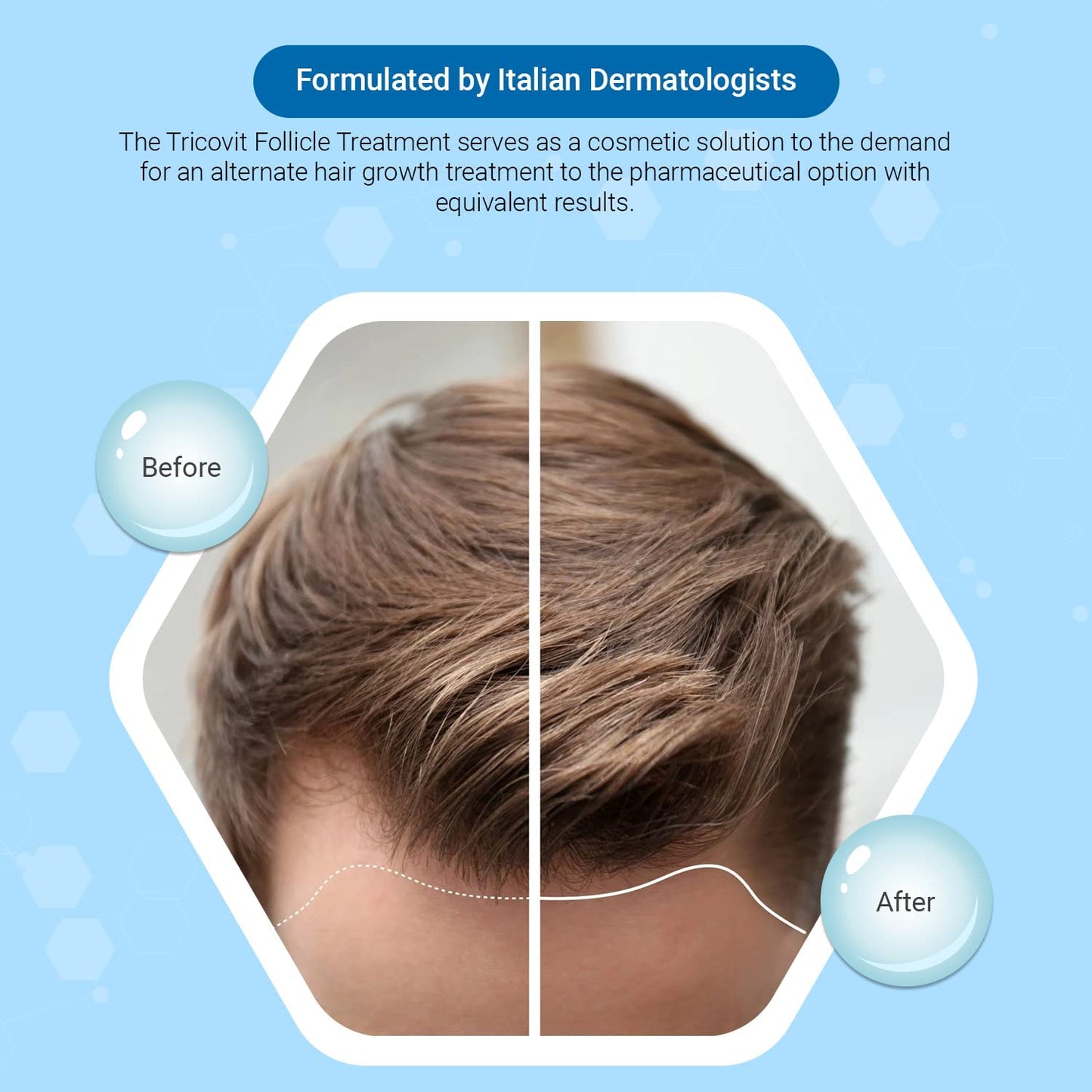 Tricovit Forte Hair Loss Treatment - Hair Growth Products for Women & Men Developed by Dermatologists - DHT Blocker & Sebum Regu