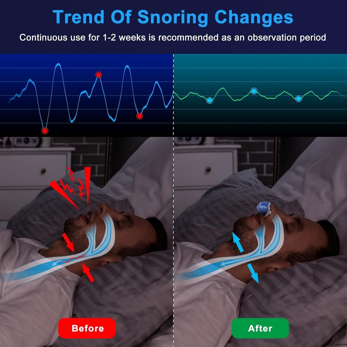 Anti Snoring Device - Mini SleepApnea Devices - Variable Anti Snoring Aid - Upgraded Stop Snoring Solution - Suitable for All Nose Shapes - Blue - Kd