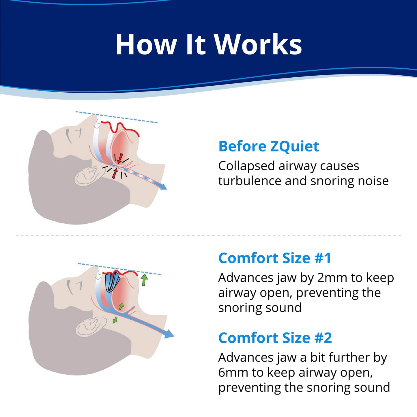 ZQuiet, Anti-Snoring Mouthpiece (Blue) + Cleaner (1.5oz Bottle), Starter Pack with 2 Sizes, Made in USA, BPA-Free, Medical-Grade Material