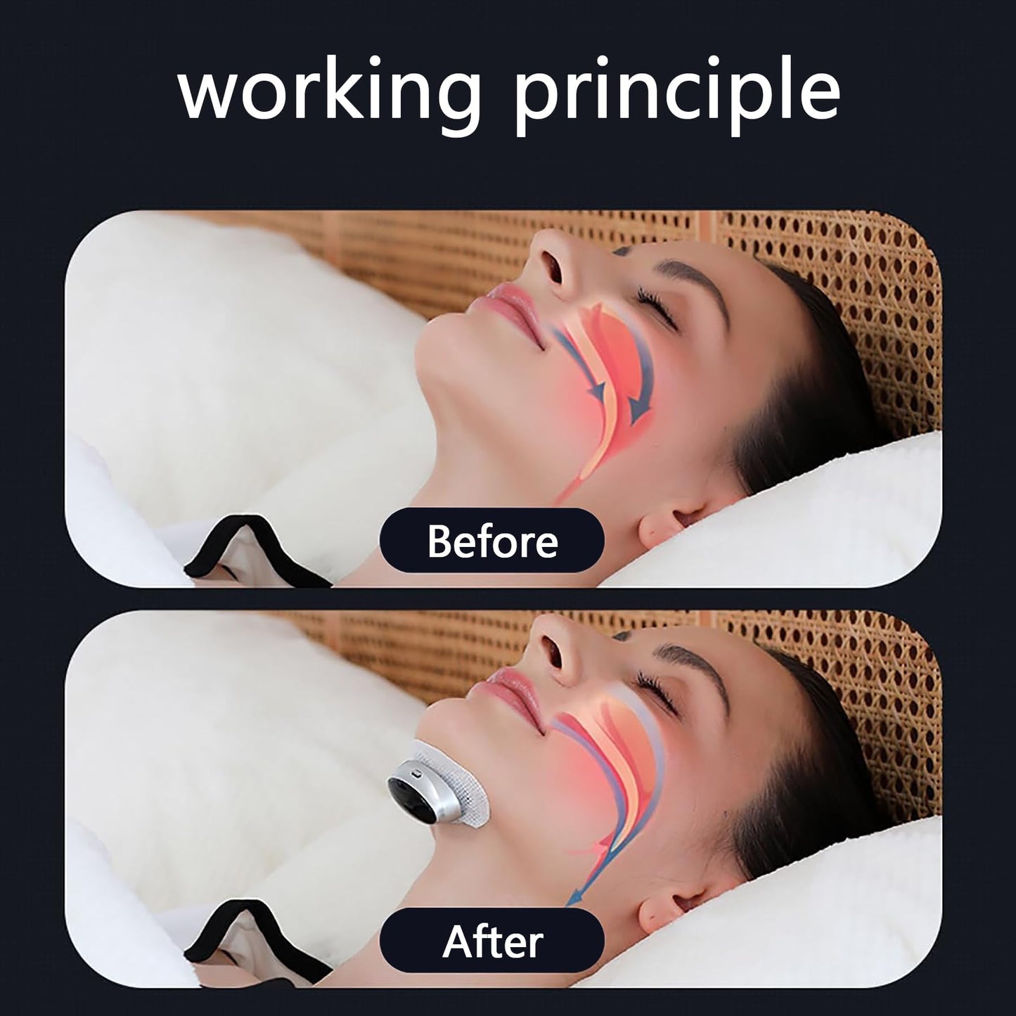 BEBESIRI Anti-Snoring Aid - Portable 3-Speed Adjustable Device for Better Sleep, Comfortable & Easy to Use (Black)