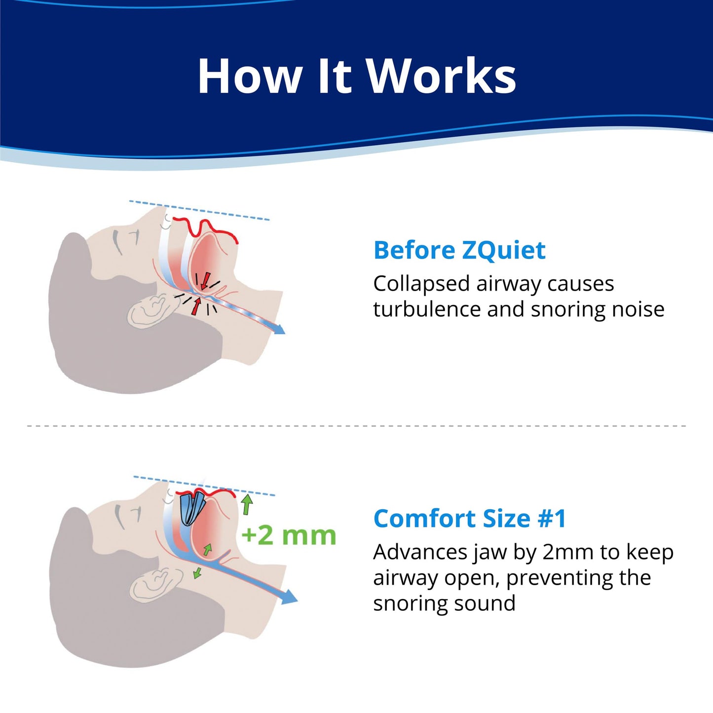 ZQuiet, Anti-Snoring Mouthpiece, Comfort Size #1, Single Refill, Blue, Made in USA, BPA-Free, Medical-Grade Material