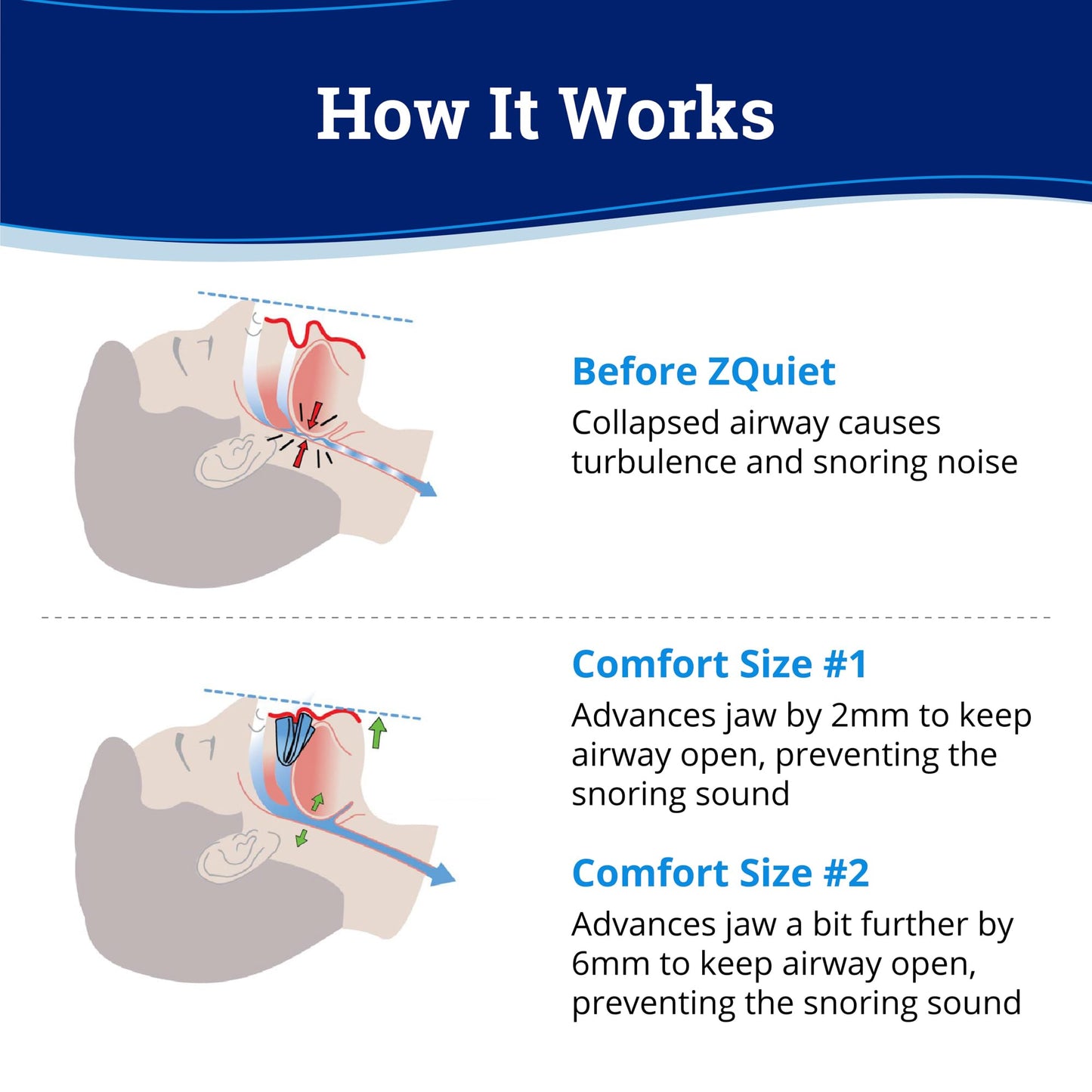 ZQuiet Anti-Snoring Mouthpiece Solution, 2 Size Comfort System Starter Kit + Nasal Dilator (2 Pack / 30 Day Supply) - Made in USA & FDA Cleared