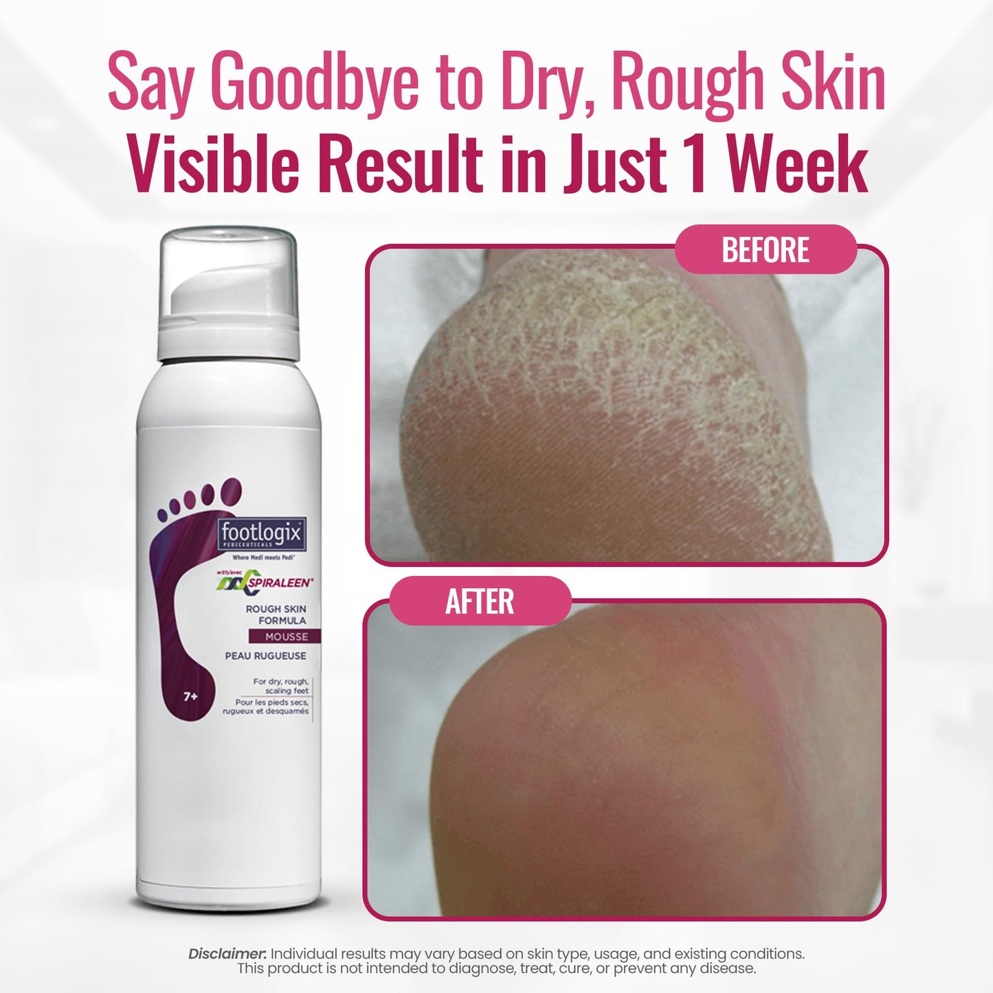 Footlogix Rough Skin Formula with Spiraleen - Mousse for Dry Cracked Heels and Feet, Foot Care for Men and Women, Dry Cracked Fe