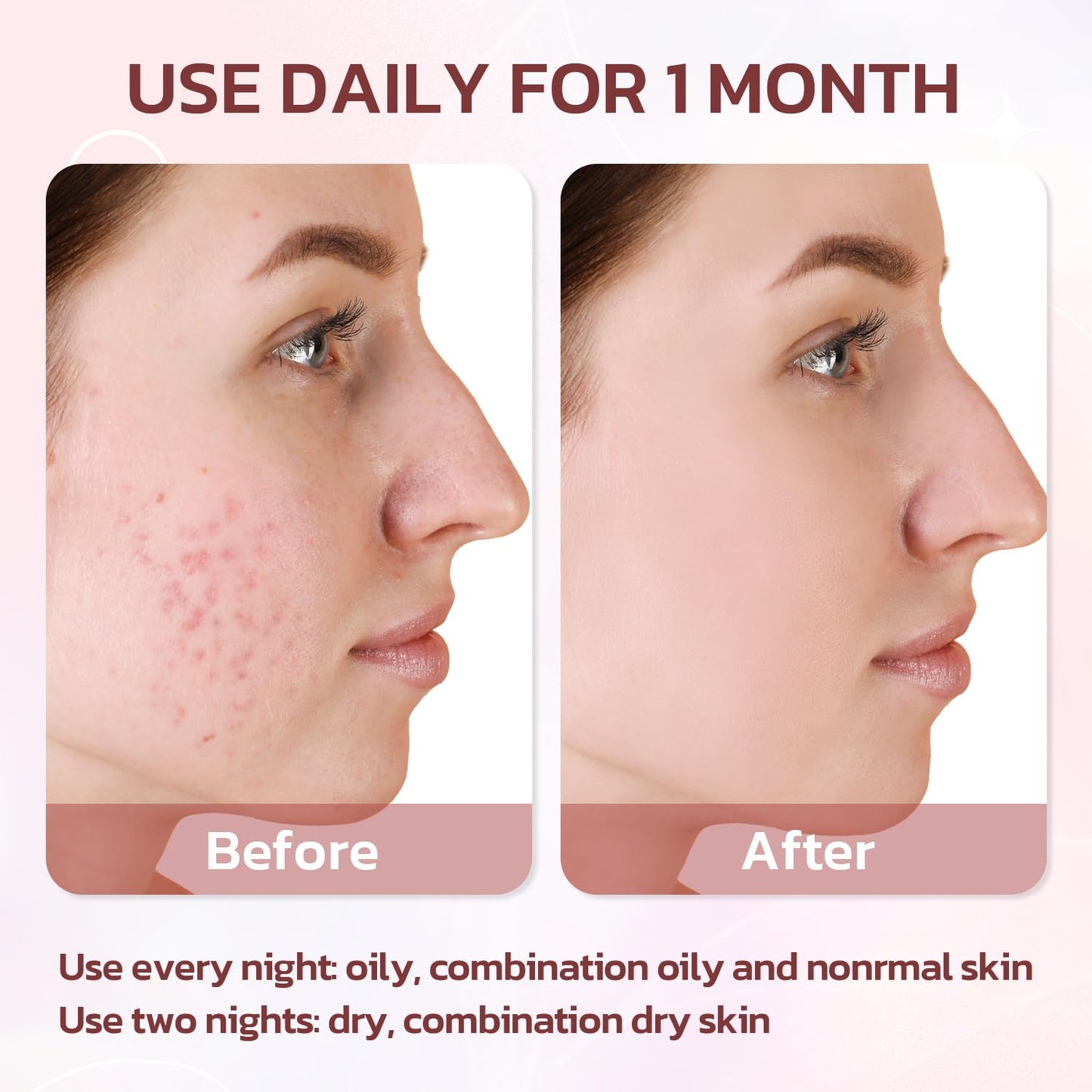 Effective Acne Treatment for Face - Acne Drying lotion - Removes Acne and Redness - Eliminating Zits - Pimple Drying Lotion 1 Fl