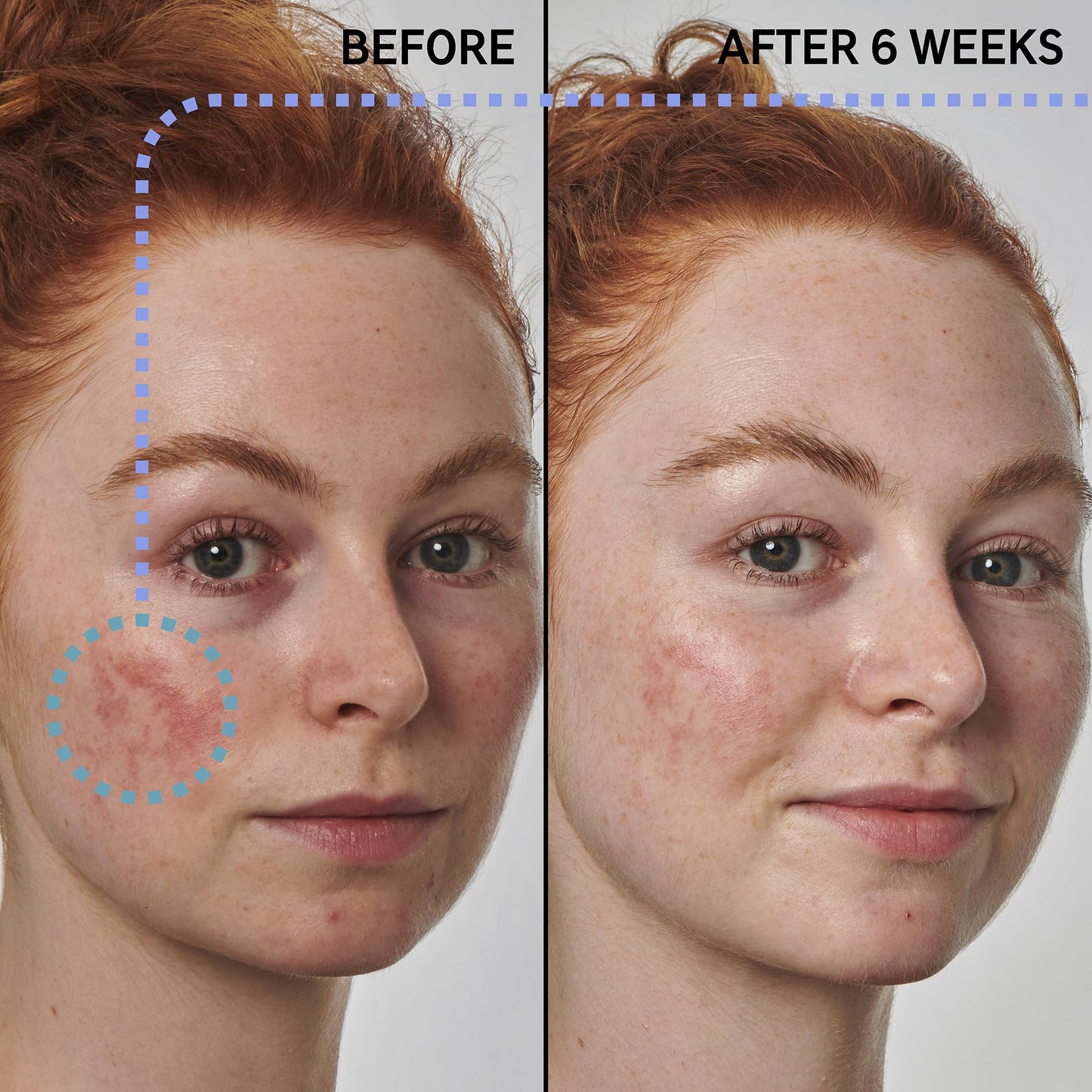 The INKEY List SuperSolutions Azelaic Acid 10% Serum, Fast-Absorbing Formula Helps Reduce Appearance of Redness and Soothes Skin